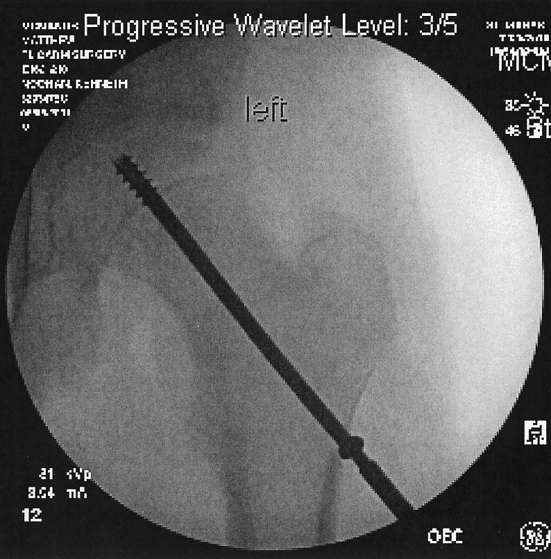 slipped capital femoral epiphysis (SCFE, "skiffy")